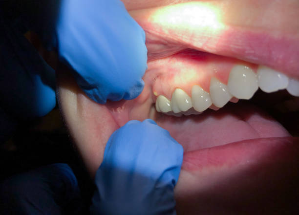 Best Emergency Dental Care for Abscessed Tooth in Thorsby, AL